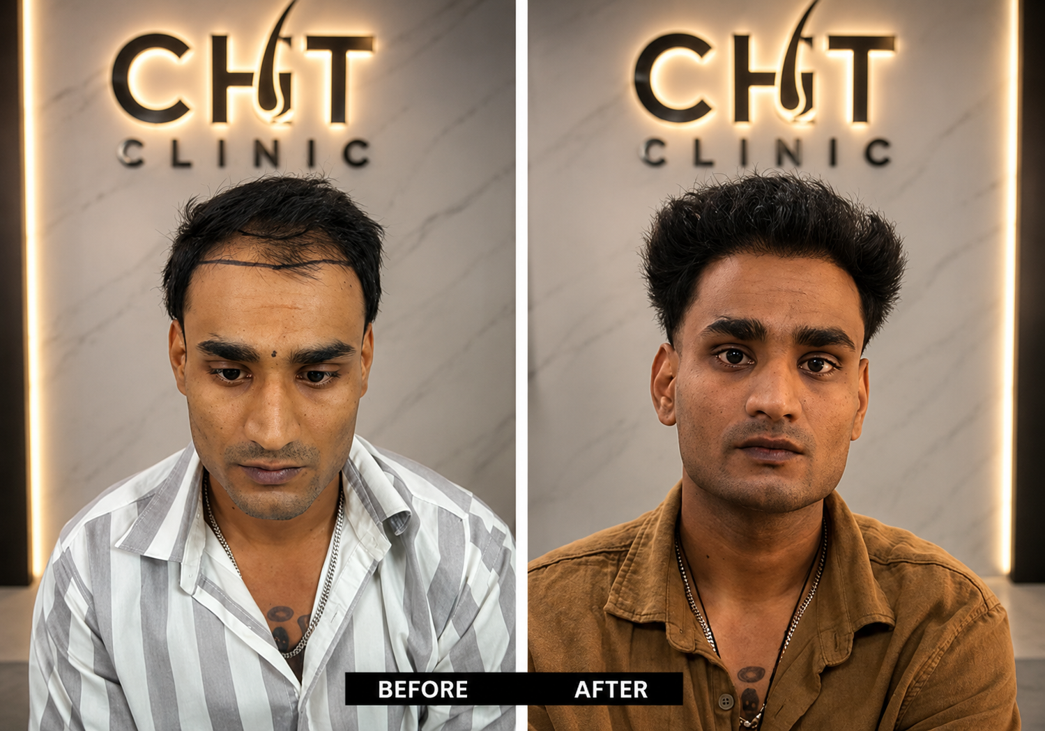 Beard Transplant Result